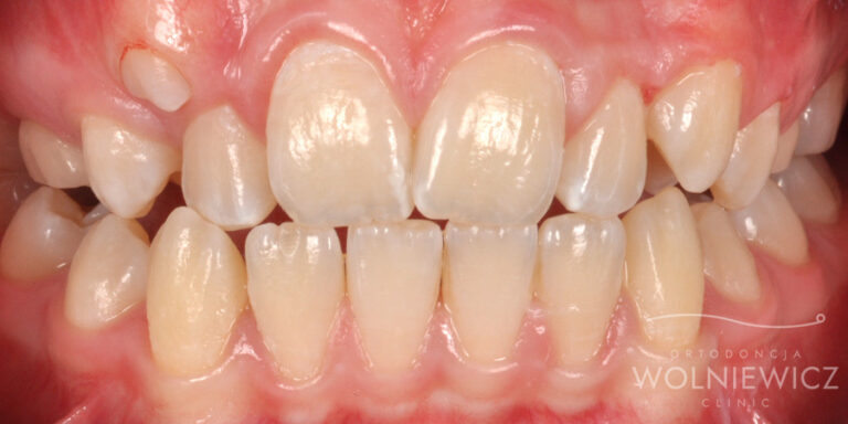 Metamorfoza 1 - przed