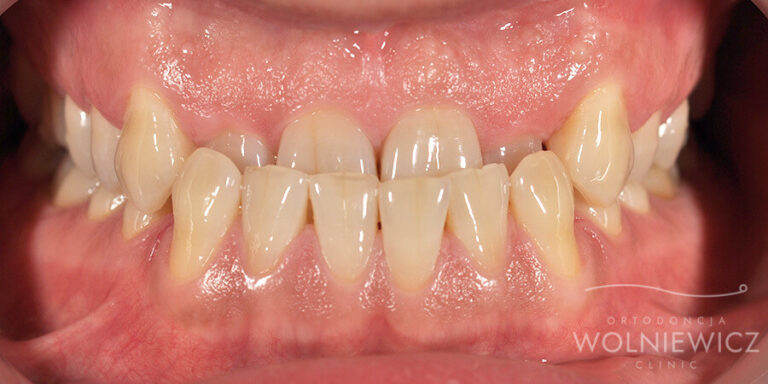 Metamorfoza 3 - przed