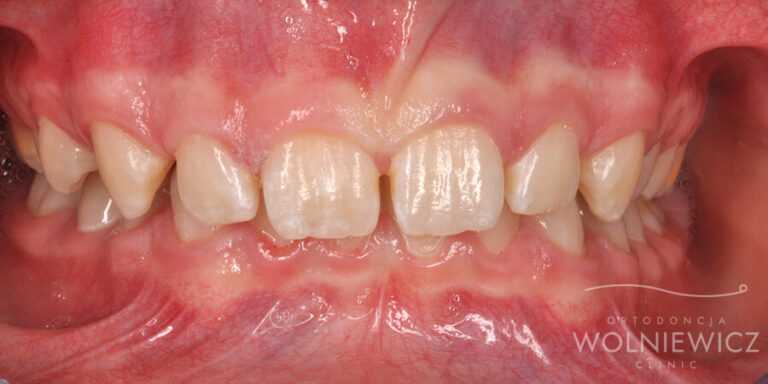 Metamorfoza 4 - przed