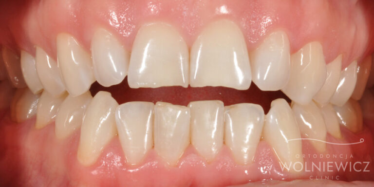 Metamorfoza 5 - przed