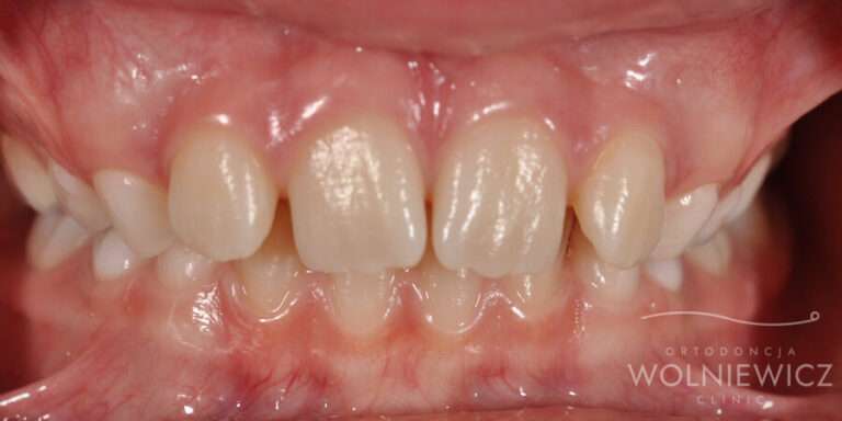 Metamorfoza 6 - przed