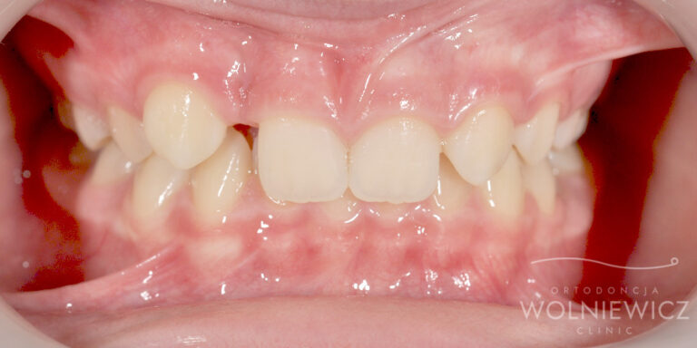 Metamorfoza 7 - przed