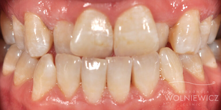 Metamorfoza 8 - przed