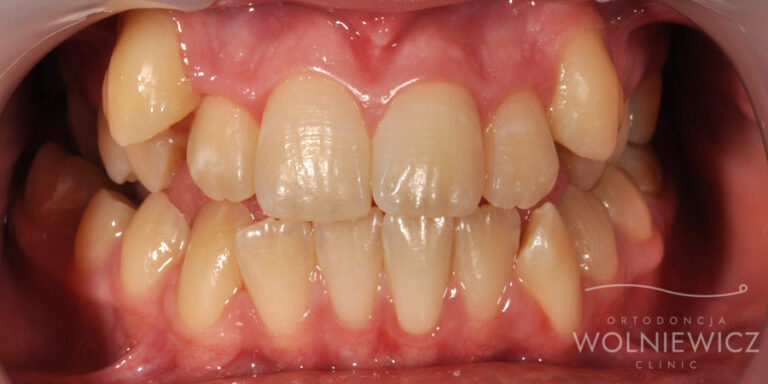 Metamorfoza 12 - przed