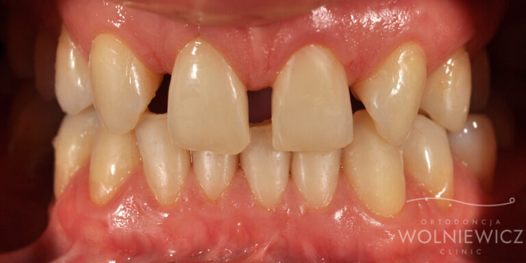 Metamorfoza 13 - przed