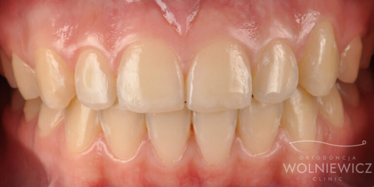 Metamorfoza 14 - przed