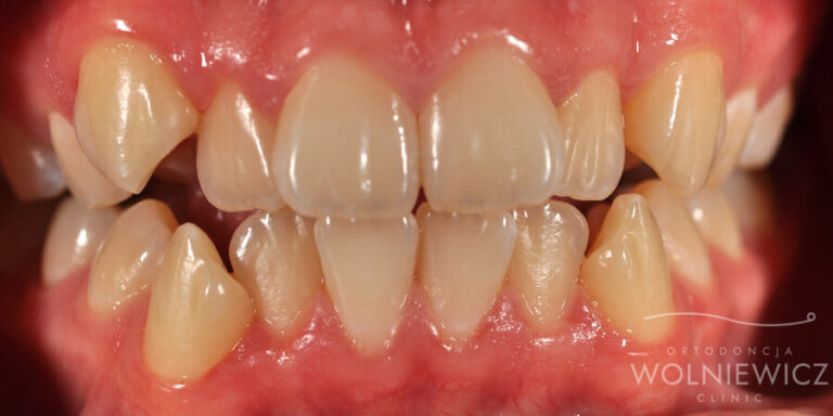 Metamorfoza 15 - przed