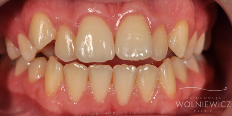 Metamorfoza 16 - przed