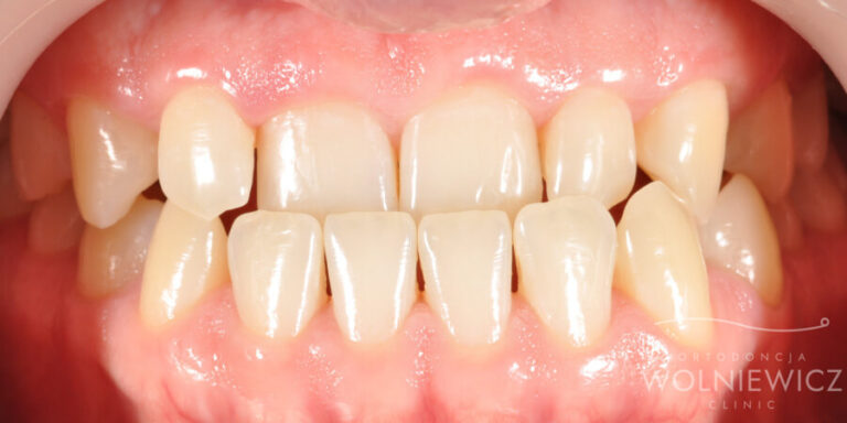 Metamorfoza 17 - przed