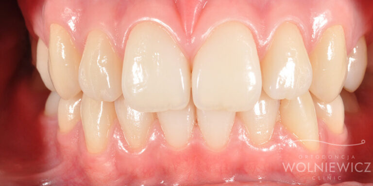 Metamorfoza 19 - przed