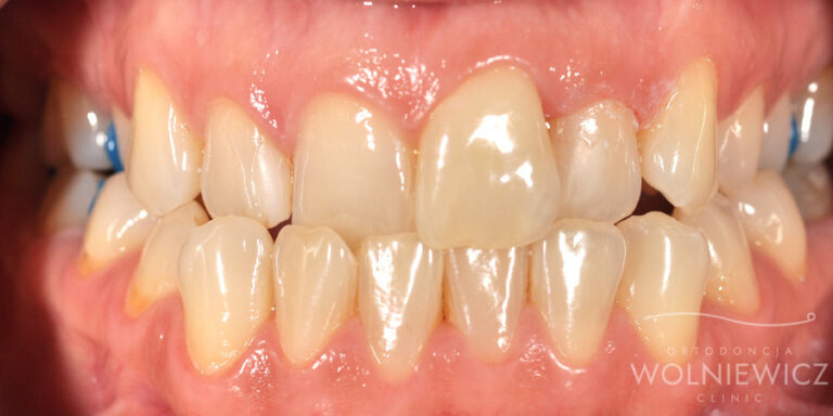 Metamorfoza 21 - przed