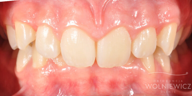 Metamorfoza 22 - przed