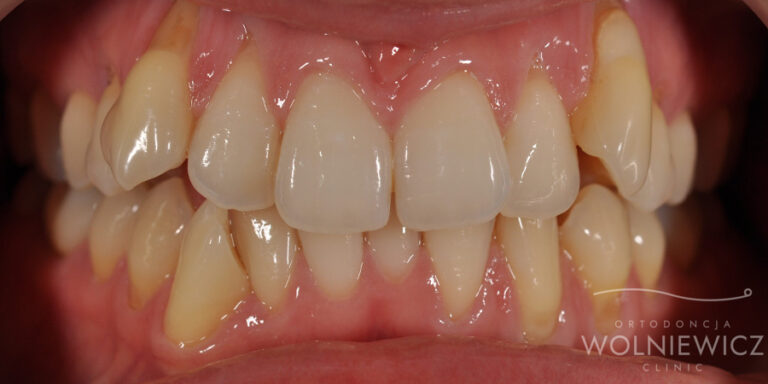 Metamorfoza 23 - przed