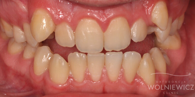 Metamorfoza 24 - przed