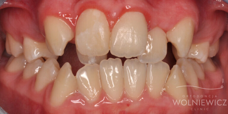 Metamorfoza 25 - przed