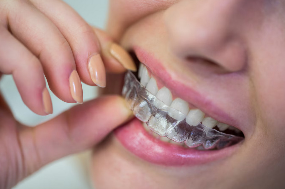 Czy nakładki Invisalign są lepsze od tradycyjnych aparatów ortodontycznych?