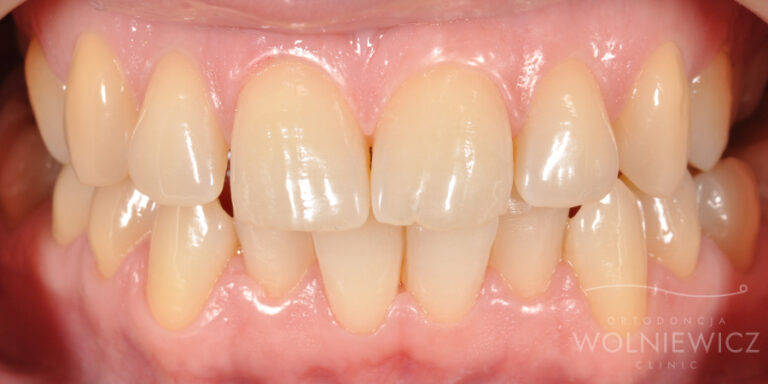 Metamorfoza 26 - przed